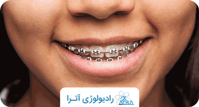 انواع ارتودنسی برای اصلاح دندان ها; کدام مناسب است؟