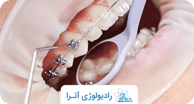اقدامات لازم قبل از کامپوزیت دندان